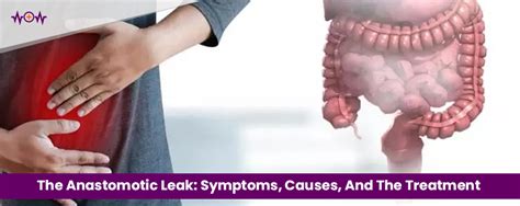 stomach leak symptoms|Anastomotic Leak: Symptoms, Causes, Treatment 